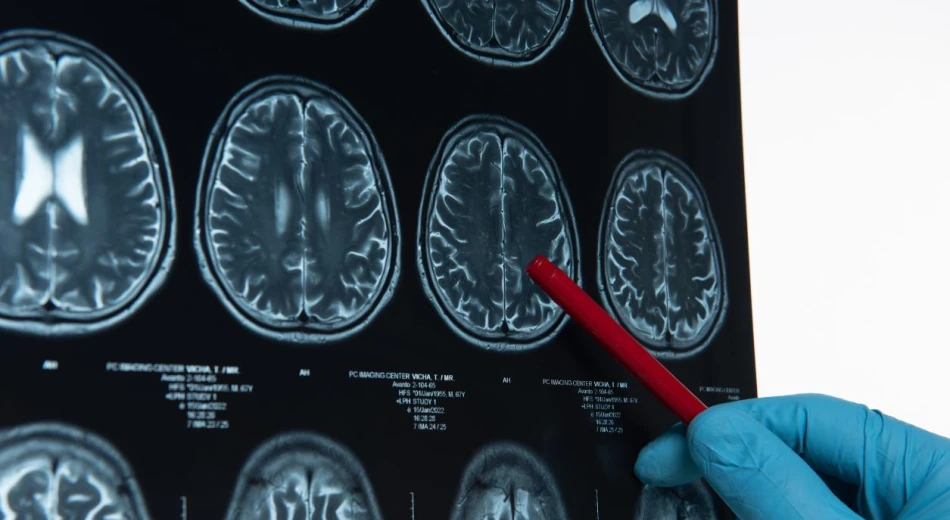 Цереброваскулярные болезни: что нужно знать