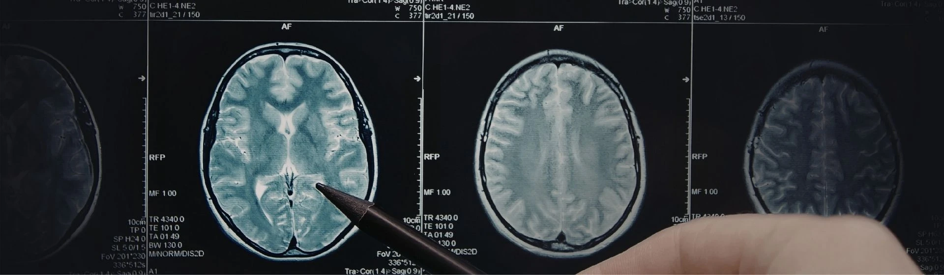 MRI of the pituitary gland (Turkish sella)