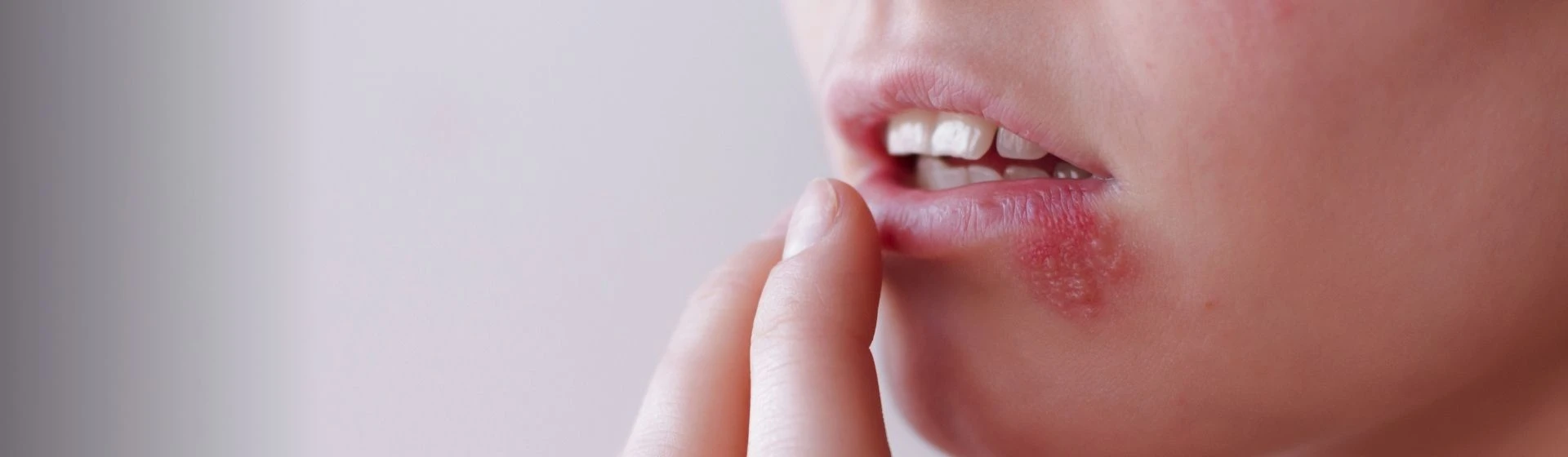 Лечение герпеса в частной клинике Оксфорд Медикал Киев