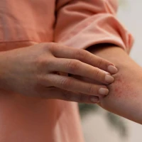 Як виглядає оперізуючий лишай та чим його лікувати