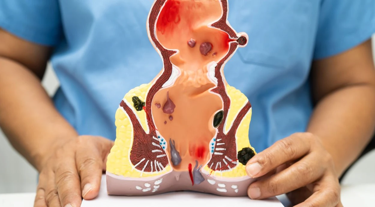 What is an anal fissure: what does it look like and what to do about it