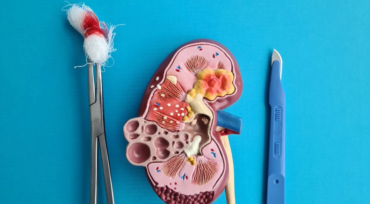 Life After a Kidney Removal: What Changes